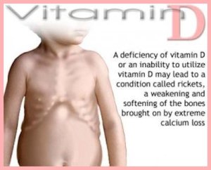 Symptoms-Of-Rickets-5-300x240